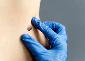 Prevencija ključna: Više od 600 ljudi u Srbiji godišnje oboli od raka kože
