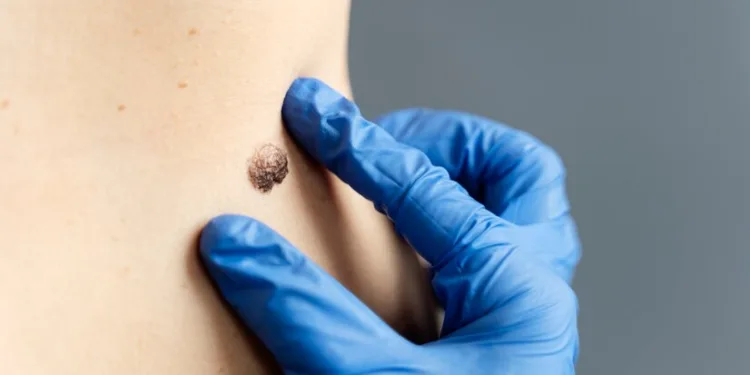 Prevencija ključna: Više od 600 ljudi u Srbiji godišnje oboli od raka kože